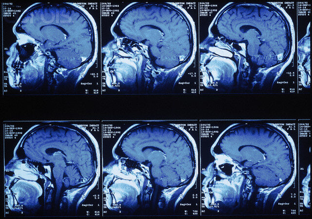 X-ray of brain from a MRI scan